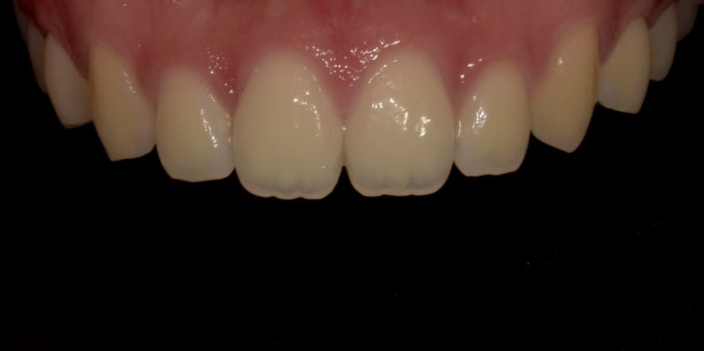 잇몸성형과 잇몸보톡스, 어떤 차이가 있는걸까요? 관련 이미지 11