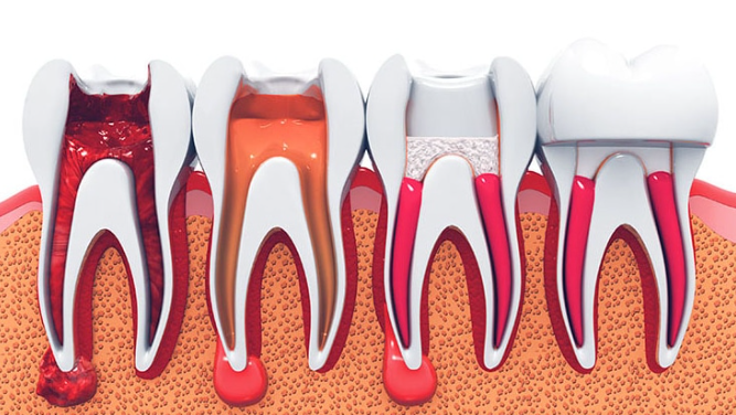 40대 전체 임플란트, 아직 젊은데 치아를 전부 발치해야만 하는 걸까? 관련 이미지 3