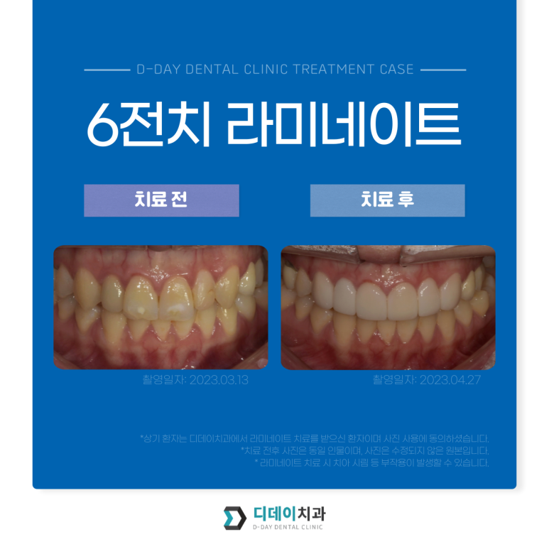 최소삭제라미네이트, 누구나 다 된다고 생각하면 오산입니다. 관련 이미지 8