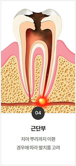 충치치료 기간, 과정, 비용까지 전문의가 알려드립니다. 관련 이미지 10