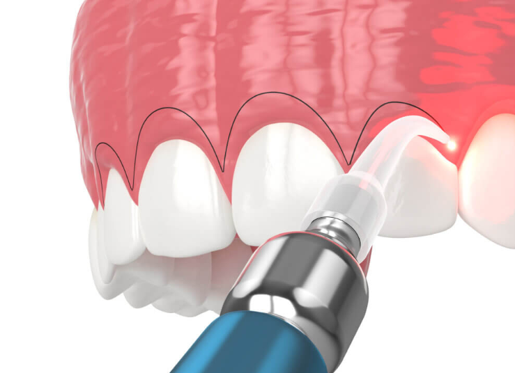 Gangnam Gum Contouring—Doesn’t It Hurt? An Honest Account of the Pain image 3