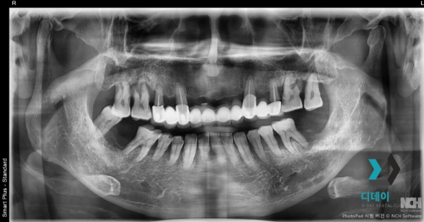 신논현역임플란트, 수술 경험 많은 의사가 알려주는 2가지 기준 관련 이미지 4