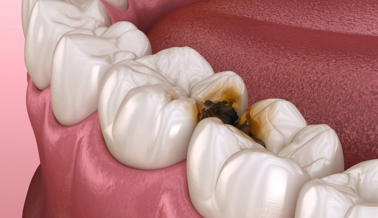 선정릉역치과, 합리적인 비용? 의사가 알려드립니다 관련 이미지 5