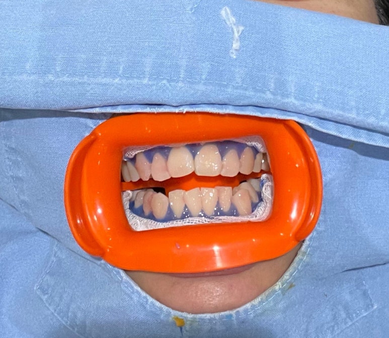 치과치아미백 #내돈내산 찐후기 (feat. 직원이 직접 받은 솔직후기) 관련 이미지 5