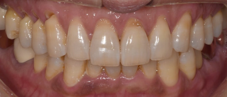 치경부마모증, 이 시린 원인과 증상부터 치료비용까지 관련 이미지 2