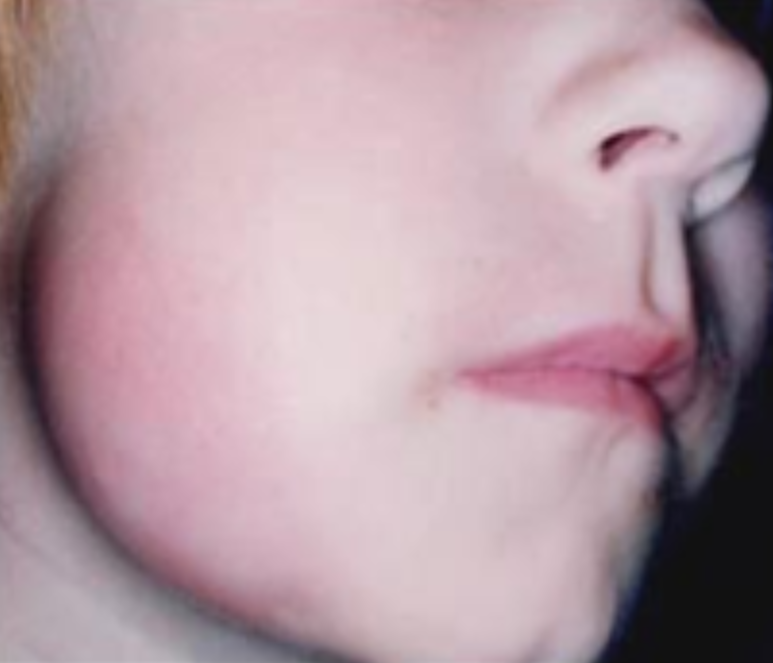 어금니잇몸물집, 방치하면 안 되는 이유 의사가 직접 설명합니다 관련 이미지 6