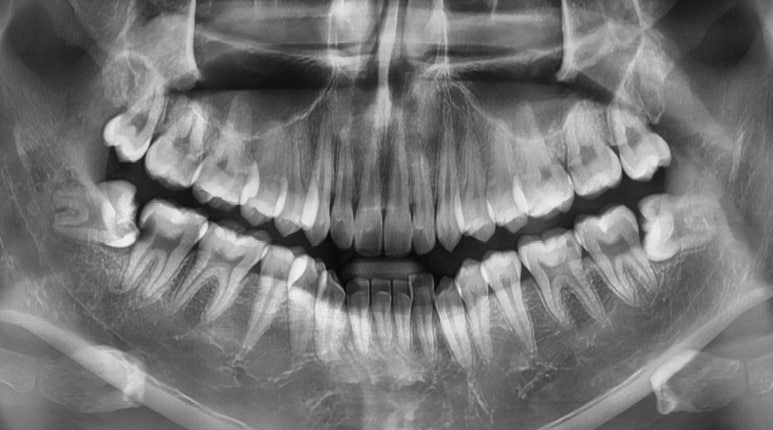 젊은나이임플란트? 젊을수록 더 빨리 심어야합니다. 관련 이미지 3