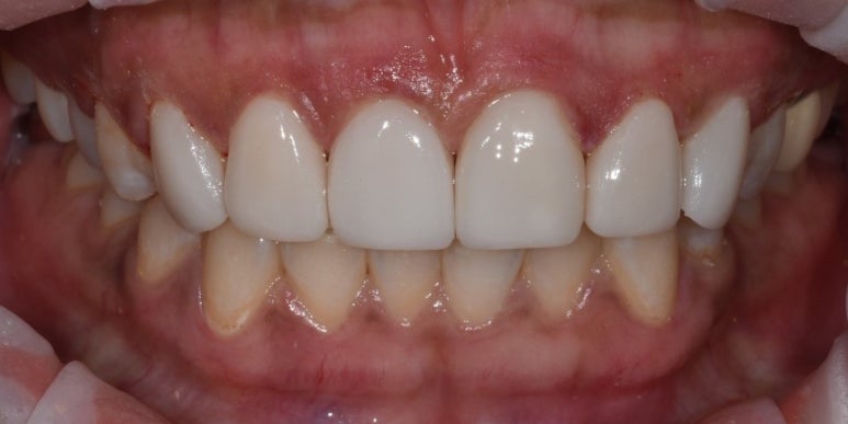 라미네이트 전후 비교, 주의사항, 비용까지 총정리 관련 이미지 14