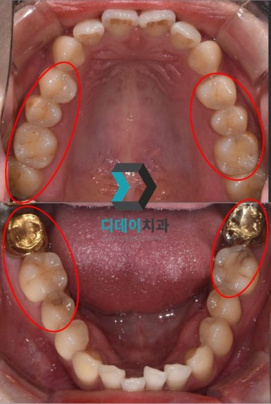 충치초기과정, 육안으로 안 보이는 이유 2가지 관련 이미지 4