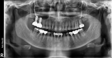 앞니임플란트, 상악동거상술임플란트 비용까지 자세히 설명드립니다. 관련 이미지 7