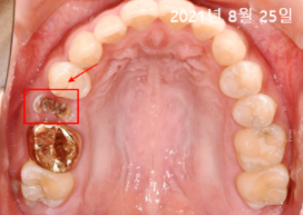 오스템임플란트비용? 이 글로 종결합니다. 관련 이미지 2
