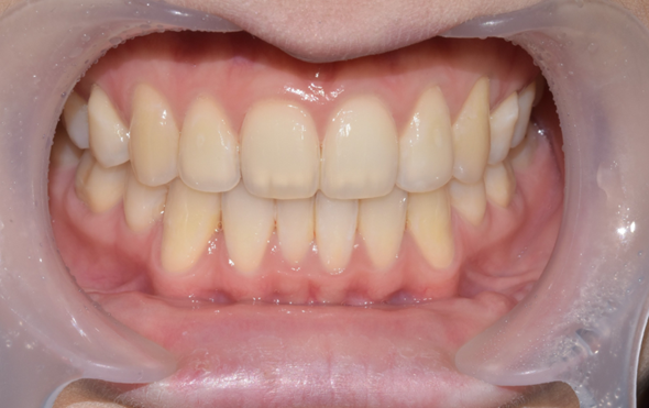 치아미백유지기간부터 종류, 주의사항까지 알려드립니다 관련 이미지 10