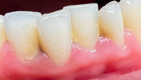 아랫니충치, 치료 미루면 안 되는 이유 2가지 관련 이미지 4