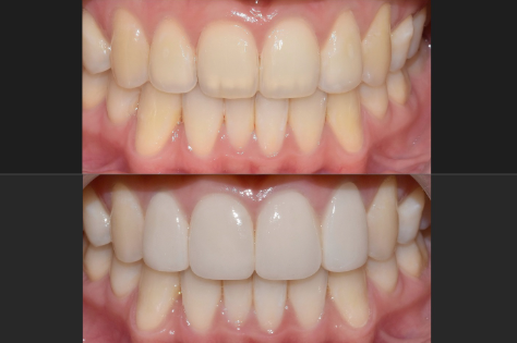 라미네이트 치과? 라미네이트 잘하는 치과 특징 3가지 관련 이미지 3