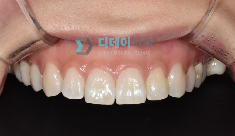 왜소치라미네이트? 앞니 치료사례 공개합니다. 관련 이미지 16