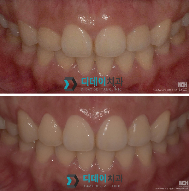 치은성형술, 잇몸이 너무 많이 보여서 웃기 싫었다면 의사 작성 관련 이미지 5