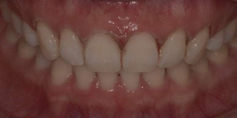 잇몸성형, OO해서 후회해요&hellip; 후회하는 이유는? 관련 이미지 8