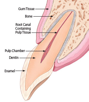 치아 검은색 치료하는 실활치미백, 방법과 비용까지 한번에 정리! 관련 이미지 4