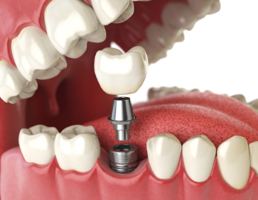 삼성역사거리 치과 임플란트 뼈이식 없이 가능 여부 의사 설명 관련 이미지 2