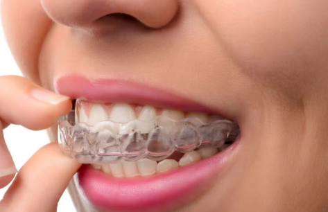 삼성역 치과 투명교정, 일반교정과 뭐가 다른지 정리해드립니다 관련 이미지 4