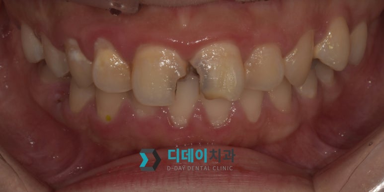 충치파절증상 초기에 발견하면 간단하게 치료됩니다 관련 이미지 4