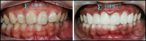 토끼이빨라미네이트? 치과의사가 정확하게 알려드릴게요. 관련 이미지 2