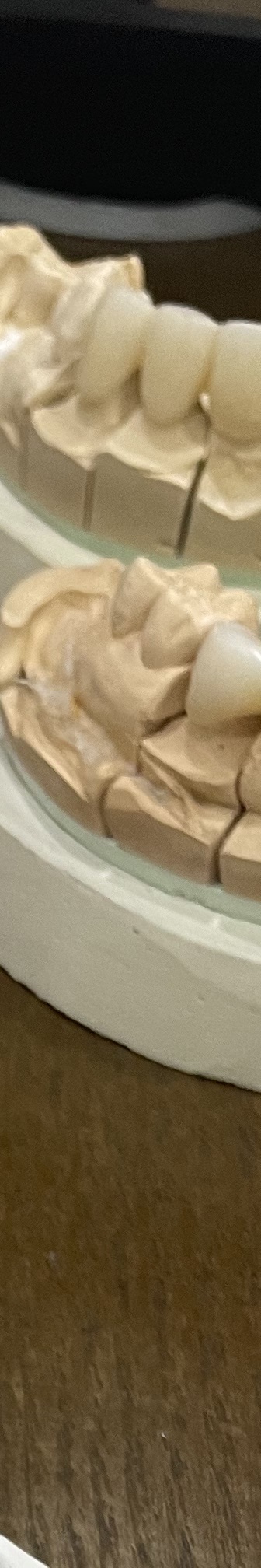 매봉역 치과, 자연치아 잃고 싶지 않다면? 관련 이미지 13