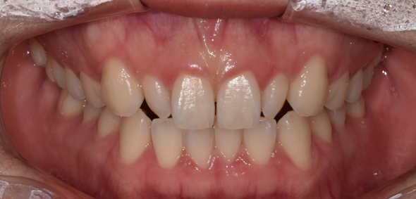 라미네이트, 치아보험 적용이 가능할까요? 관련 이미지 9