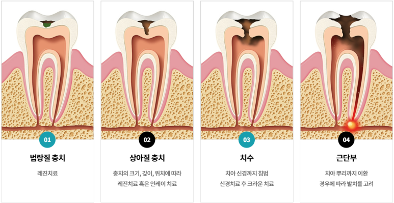 치과세라믹가격, 치과의사가 낱낱이 알려드립니다. 관련 이미지 2