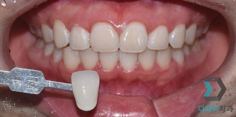 디데이치과에서 알려드리는 치아미백 관련 이미지 3