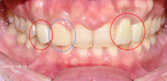 어금니발치후임플란트? 꼭 받아야 할지 궁금한 분은 보세요. 관련 이미지 3