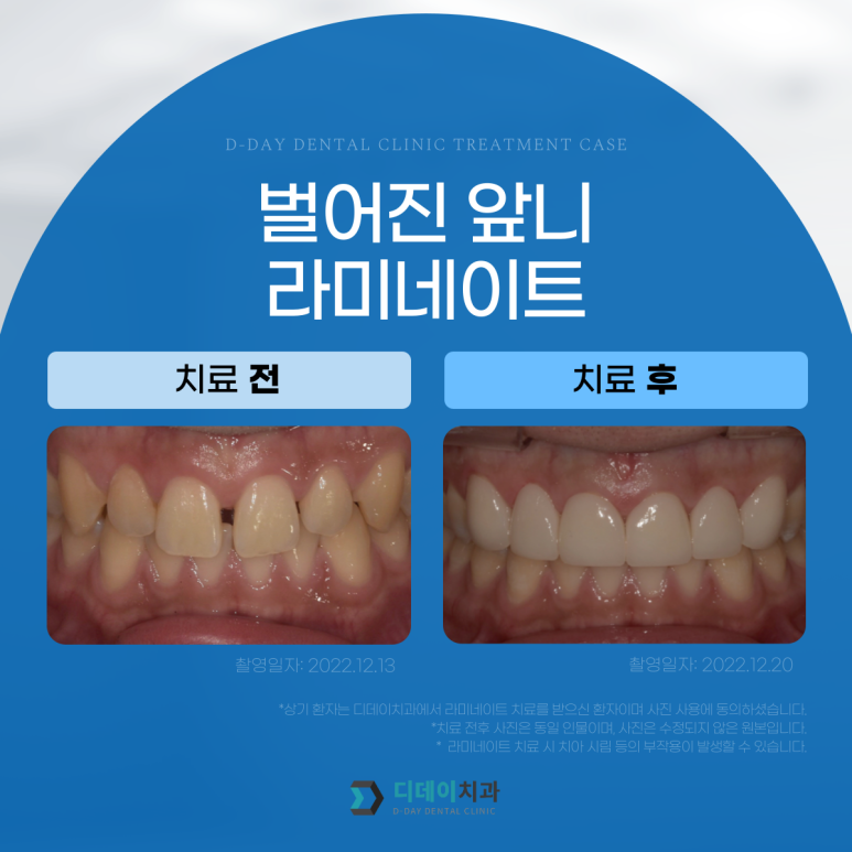 강남라미네이트 잘하는 곳 선택법, 치과의사가 알려드립니다. 관련 이미지 7