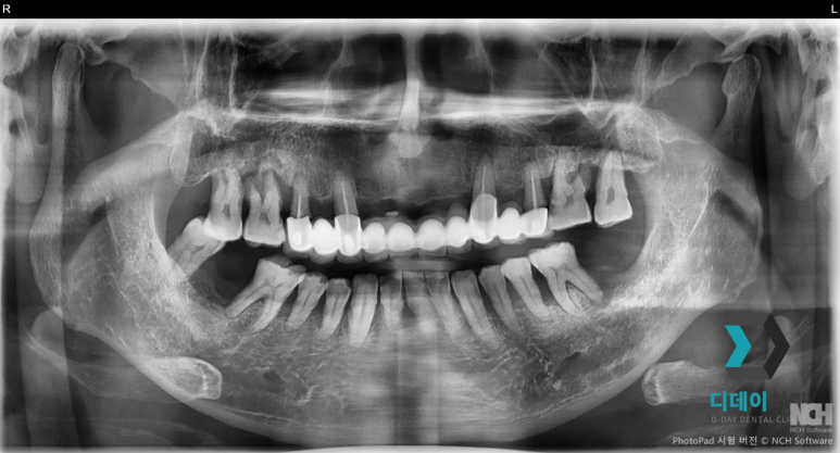 치주염치료비용보다 관련 이미지 8