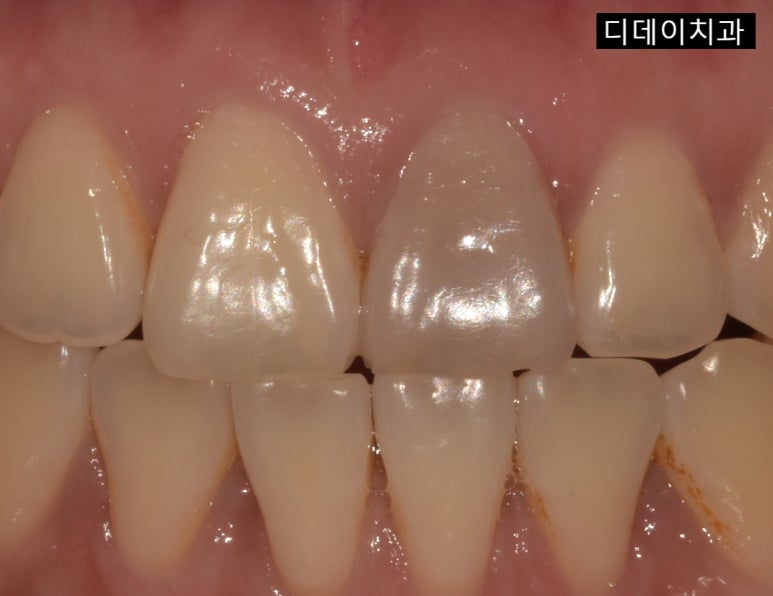 치아착색? 치아변색? 하얀 치아로 만드는 방법 공개 관련 이미지 5