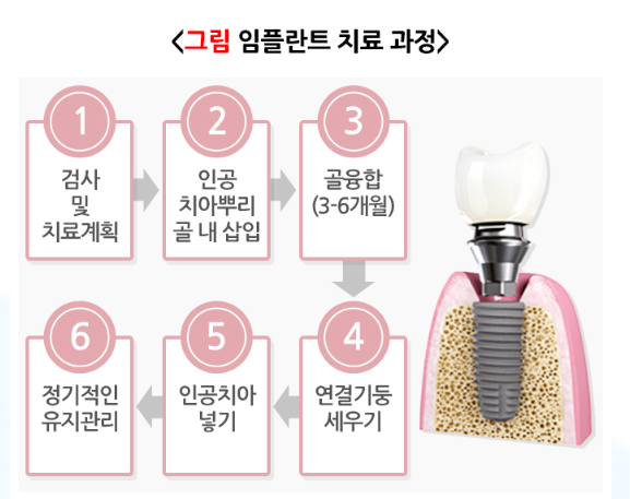 Dental Implant Re-treatment in Seocho-gu: Where You Have It Done the First Time Makes All the Difference image 2