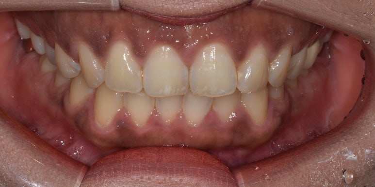 잇몸착색, 변색되어 검은 잇몸 선홍빛으로 되돌리는 방법 관련 이미지 3