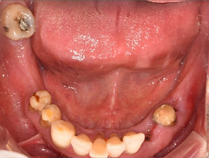고령자임플란트 보험 적용받을 때 주의할 점 관련 이미지 5