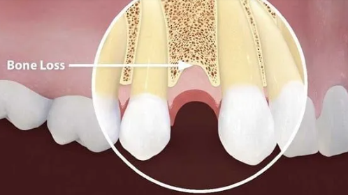 치조골 증대술 , 베테랑들도 어려워하는 이유 관련 이미지 4