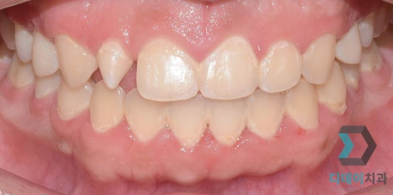 작은이빨, 왜소치? 치아 크기를 키우고 싶은 분만 <필독> 관련 이미지 9
