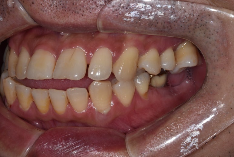 상악동거상술과 뼈이식임플란트 실제 치료사례로 보여드립니다. 관련 이미지 10