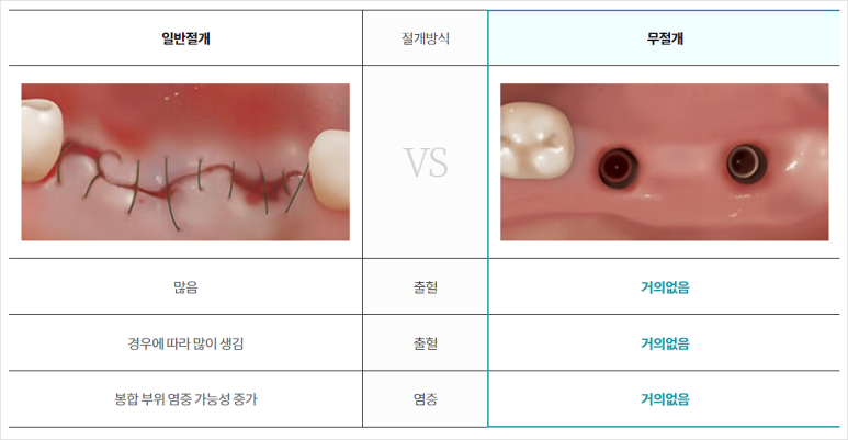앞이빨임플란트, 내 치아처럼 감쪽같으려면? 관련 이미지 8