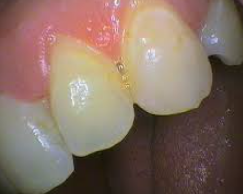 충치파절증상 초기에 발견하면 간단하게 치료됩니다 관련 이미지 3