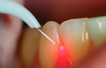 Curettage, for Gum Health image 6
