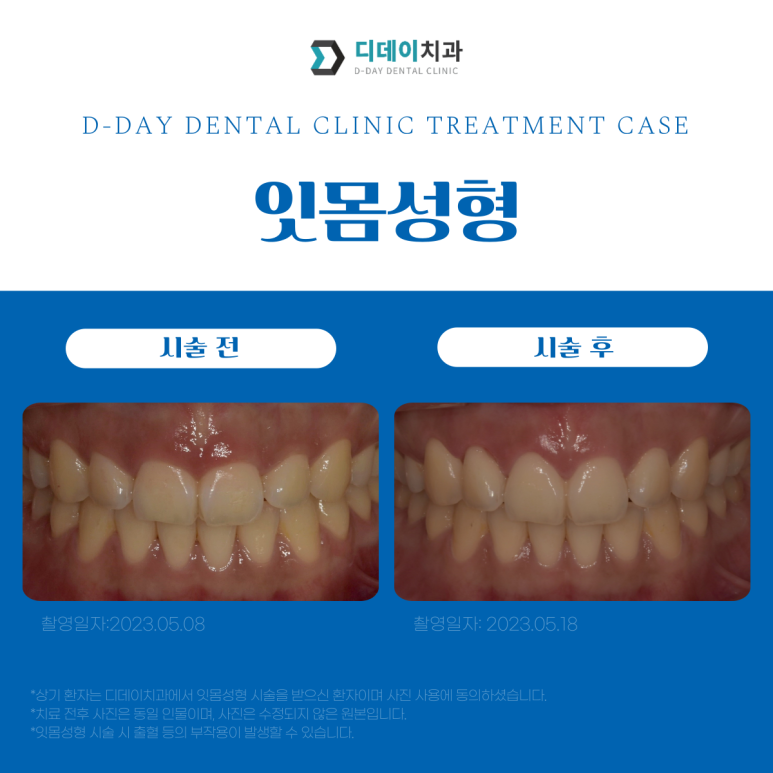 잇몸성형과 잇몸보톡스, 어떤 차이가 있는걸까요? 관련 이미지 4