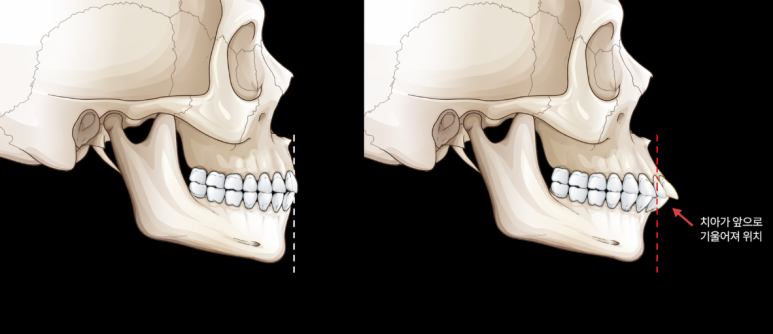 Protruding Mouth Laminate: Read This If Your Side Profile Has Been Especially on Your Mind image 3