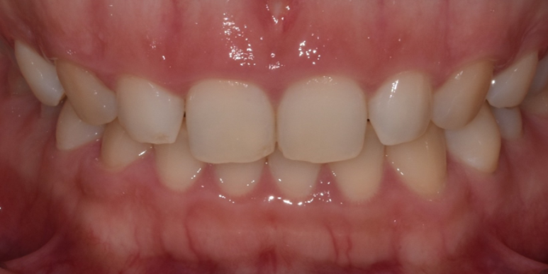 잇몸성형가격? 비용, 주의사항, 치료 후기 공개 관련 이미지 9