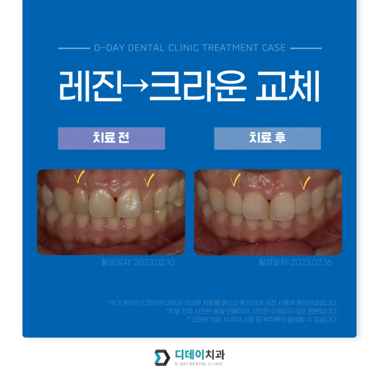앞니성형, 종류별 가격과 전후사진까지 완벽 정리 관련 이미지 20