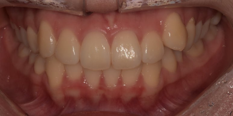 덧니교정만 된다? 라미네이트로도 덧니 치료 가능합니다. 관련 이미지 5