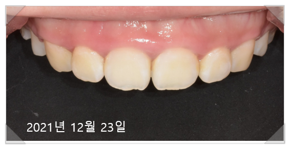 잇몸수술비용? 이 글로 종결합니다. 관련 이미지 8