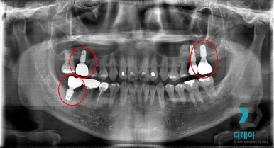역삼동 임플란트 뼈이식 필요성부터 통증까지, 이 글 하나만 보시면 됩니다. 관련 이미지 4